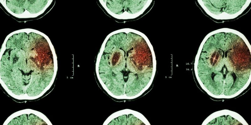 diegersi vitamini c dysfagia egkefaliko epeisodio