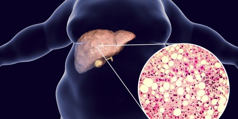 metabolic syndrome